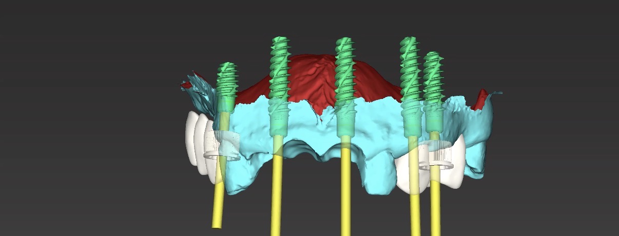 Digitale Implantatplanung am Computer