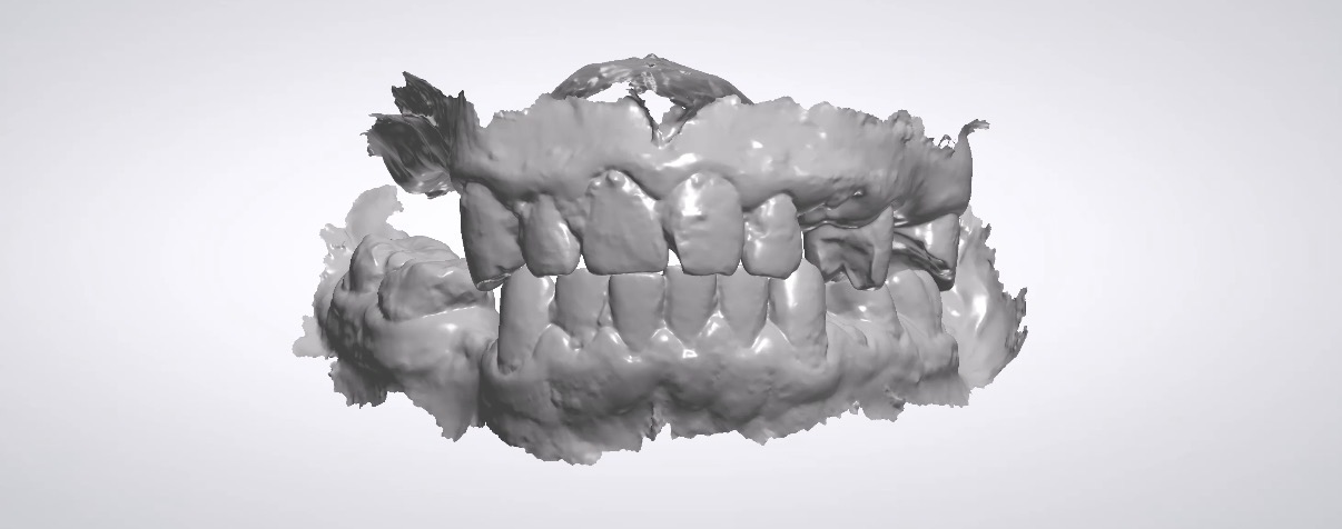 Digitaler 3D-Scan der Zähne und des Kiefers