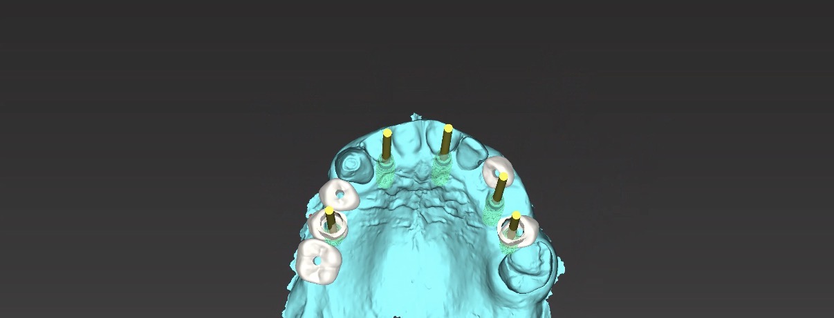 3D-geführte Bohrschablone für die Implantatsetzung